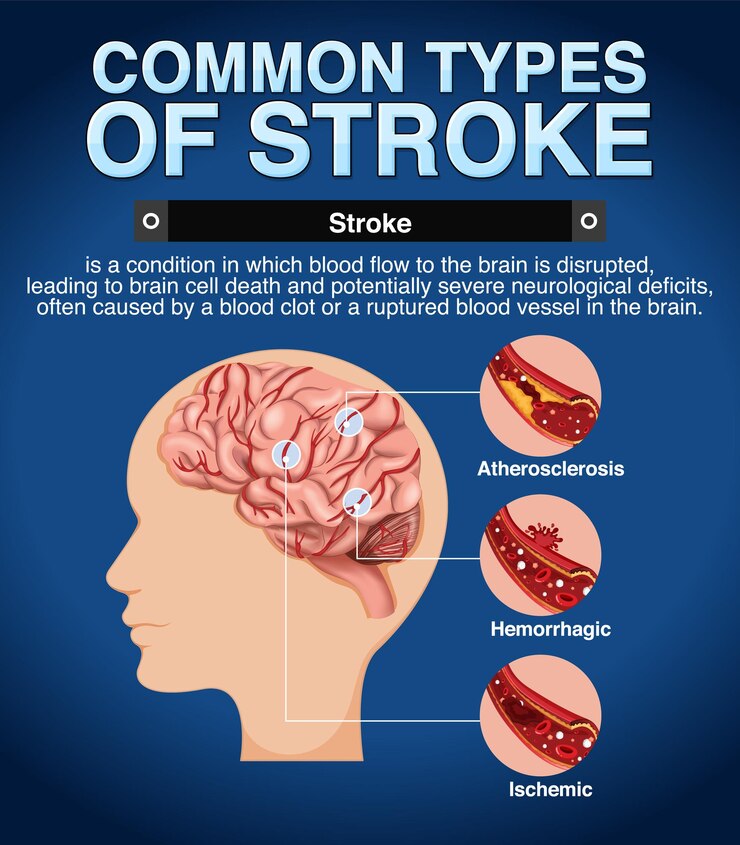 Types of Strokes - Detecting-Silent-Killers--health-blog---NDC---North-City-Diagnostic-Centre