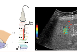 USG FIBROSCAN