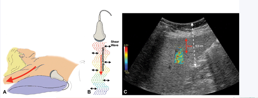 USG FIBROSCAN